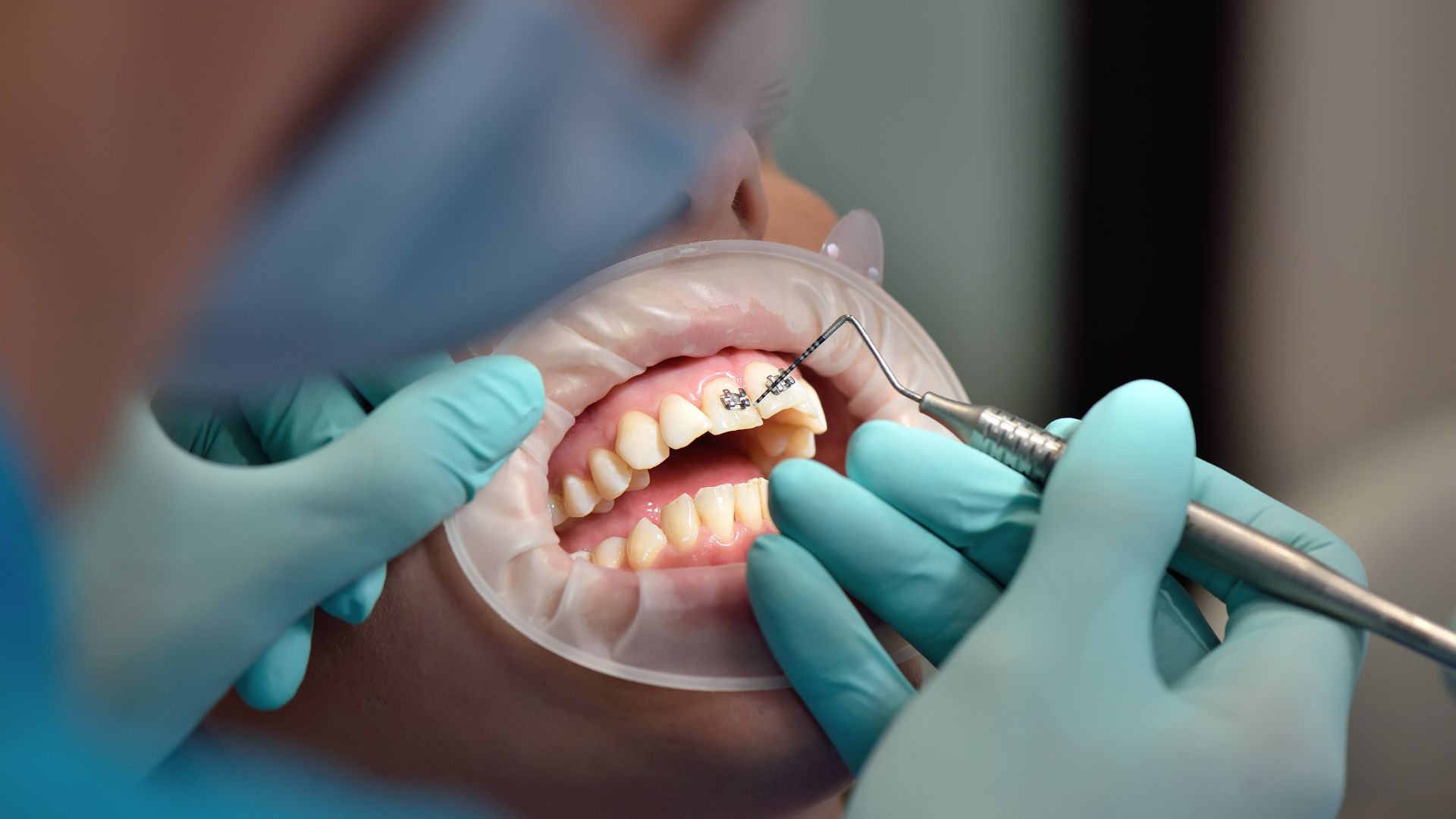 Justiça suspende greve e dentistas da rede municipal mantêm atendimentos em Campo Grande