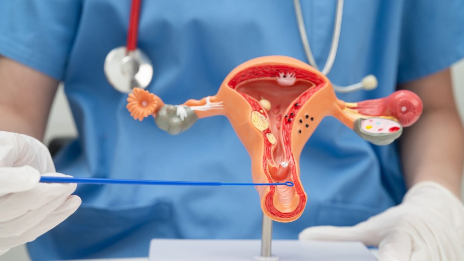 Exame gratuito para prevenir câncer do colo do útero está disponível em unidades de saúde de Campo Grande